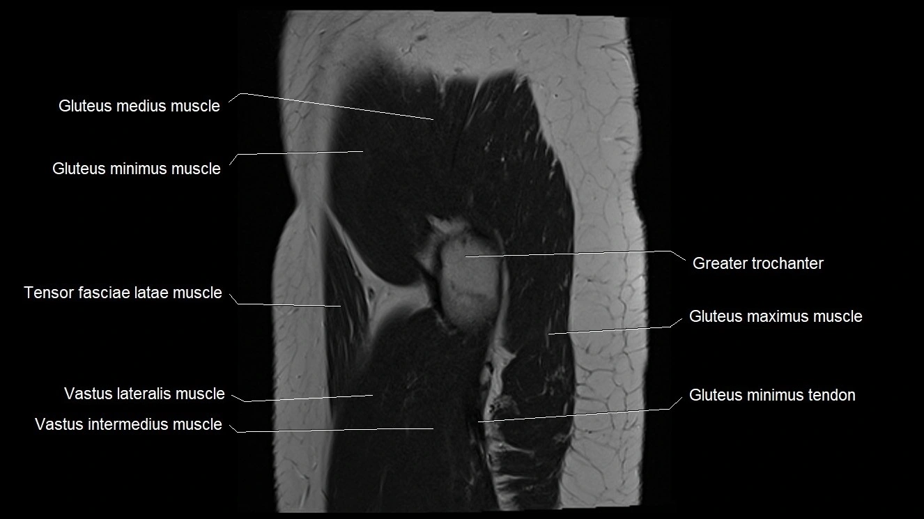 Hip sagittal cross sectional anatomy image 6.webp